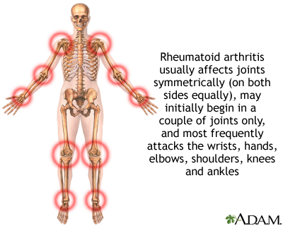 Rheumatoid Arthritis Food Chart